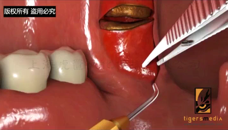 医学手术动画有哪些优势-虎置文化集团