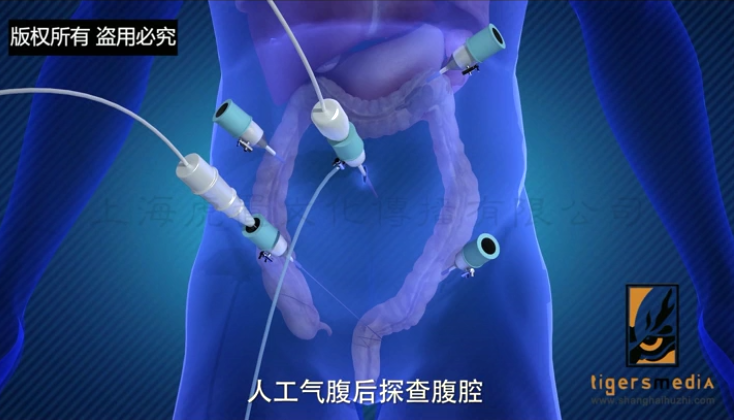 宏葵医疗动画-2.png